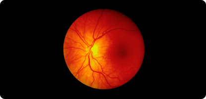 ARTICLE : Pediatric Retina: Advances in Diagnosis and Treatment : Widefield imaging, anti-VEGF agents and shorter instruments expand management options.