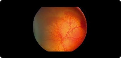 ARTICLE : Innovations in technology and service delivery to improve Retinopathy of Prematurity care.