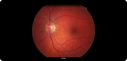 Ultra-Widefield Imaging for Pediatric Retinal Disease.