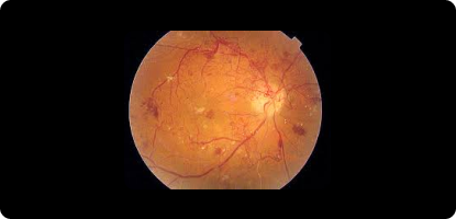 Accuracy of trained rural ophthalmologists versus non-medical image graders in the diagnosis of diabetic retinopathy in rural China.