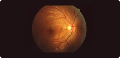 Wide-Field Fundus Photography.