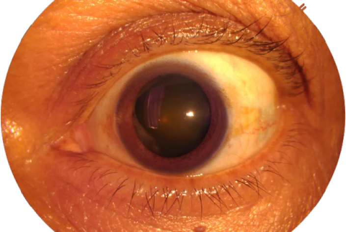 cataract img1 mob