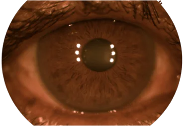 cataract img2 mob