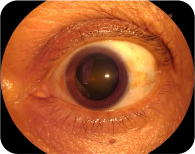 Cataracts img new