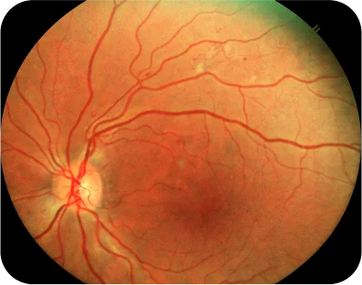 Diabetic Retinopathy