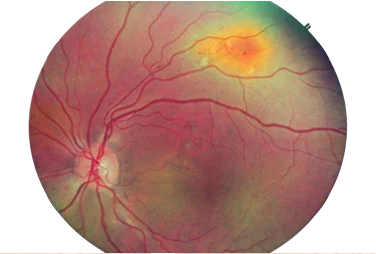 DR Retinal Images mob 1