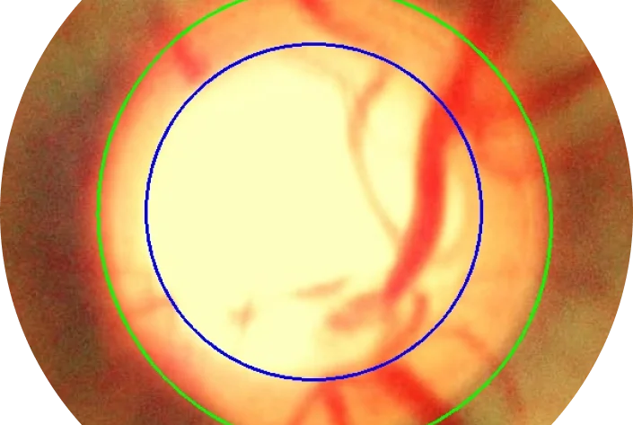 glucoma retina img1 mob