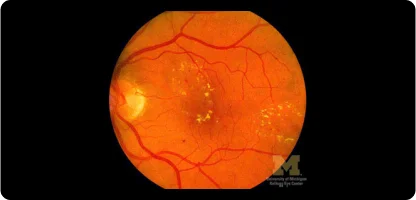 An ensemble approach to detect exudates in digital fundus images.